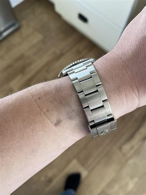 rolex oyster bracelet leaving marks on skin|Oyster bracelet grease marks : r/rolex .